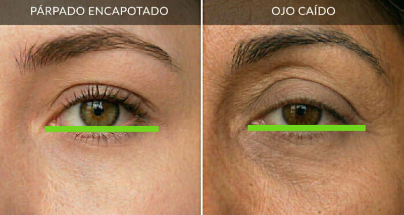 Comparativa visual entre párpado encapotado y ojo caído para identificar la forma del ojo antes del maquillaje.