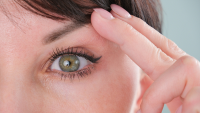 Párpado encapotado o caído